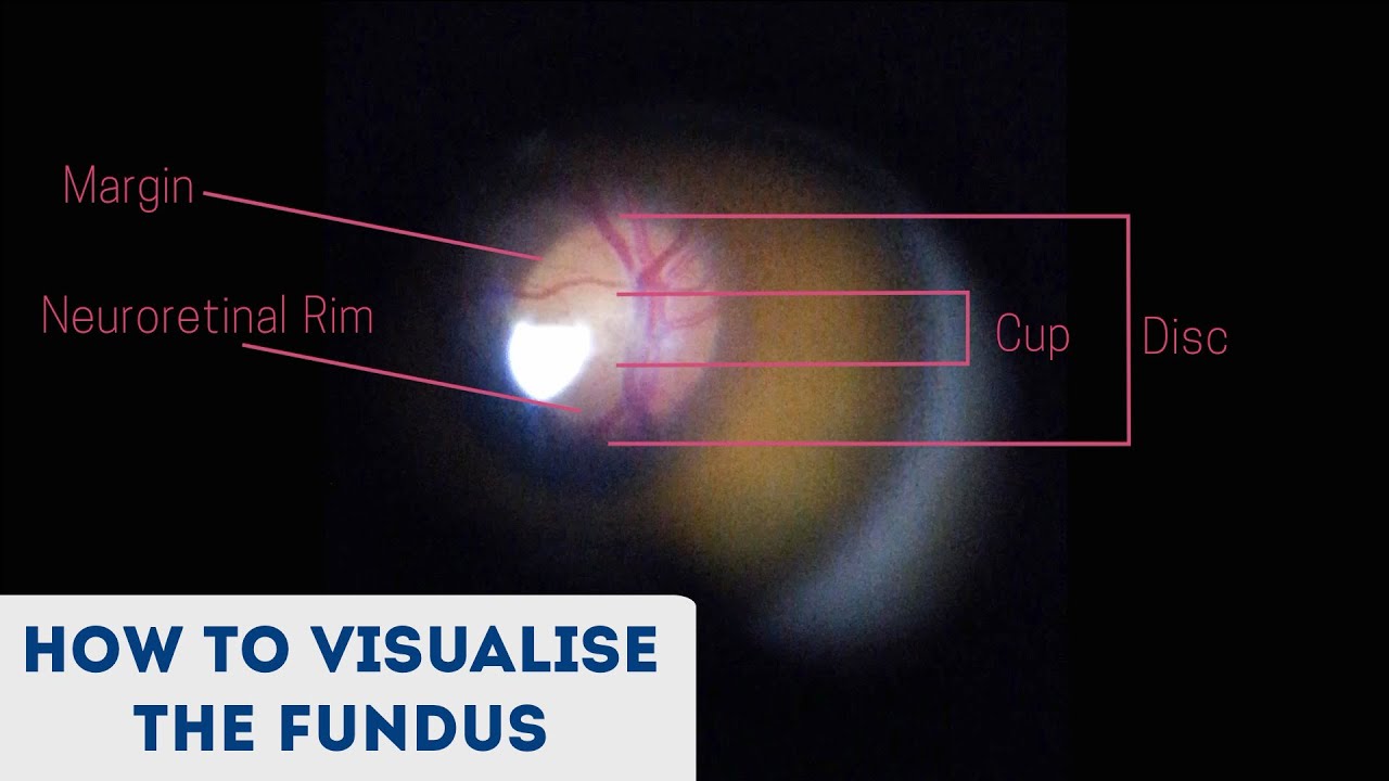 Fundus examination: what it is and how it is performed