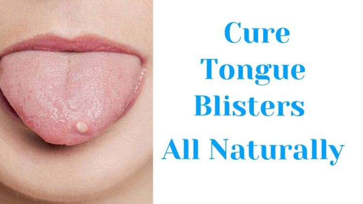 Grains on the tongue, how to remove them? - Health & Fitness